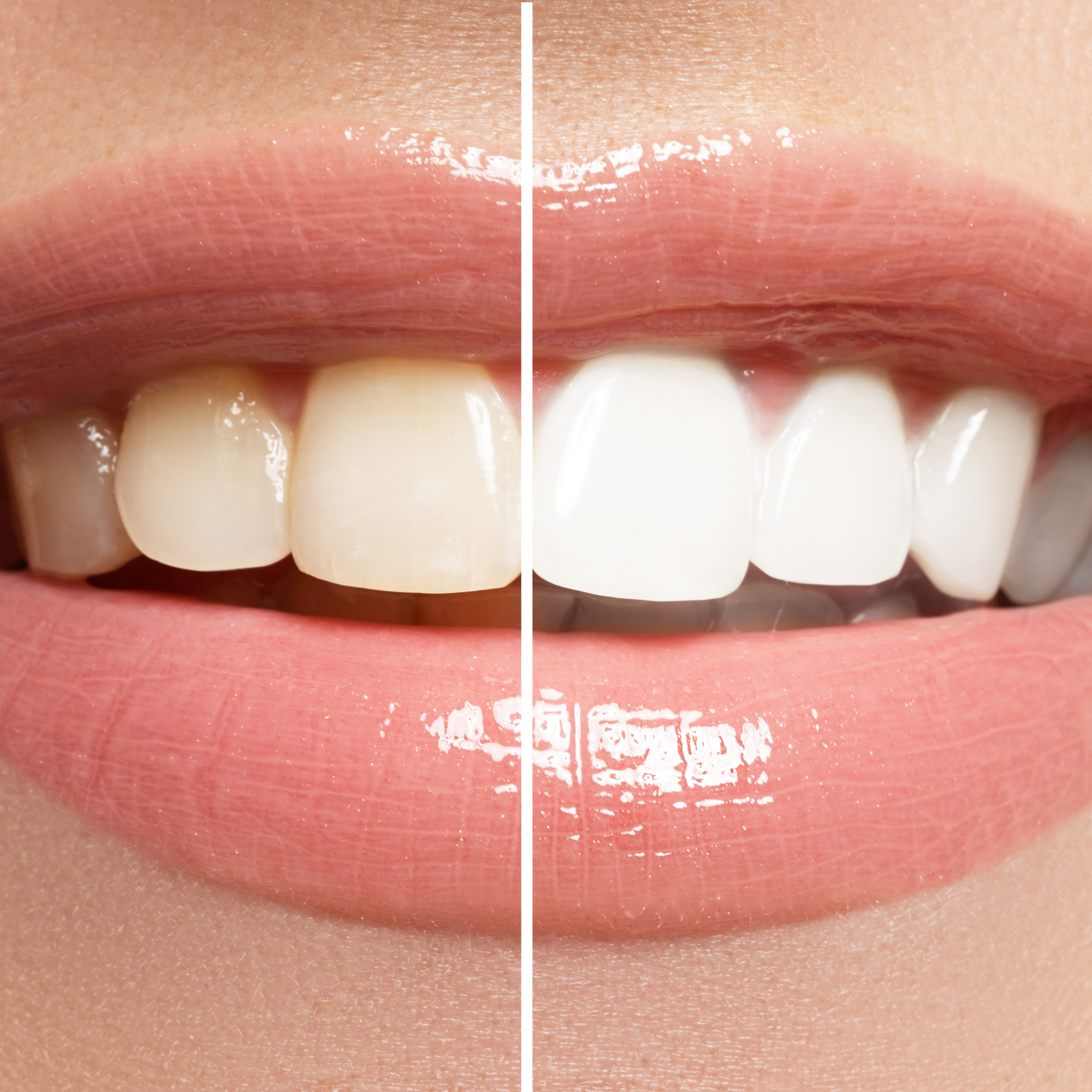 Perfect smile before and after bleaching. Dental care and whitening teeth